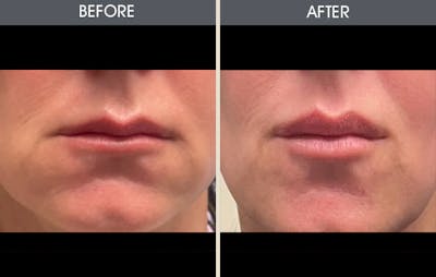 Lip Fillers Gallery Before & After Gallery - Patient 325187 - Image 1