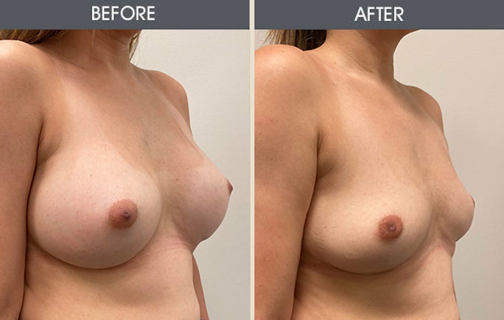 Breast Implant Removal Gallery Before & After Gallery - Patient 270411 - Image 2