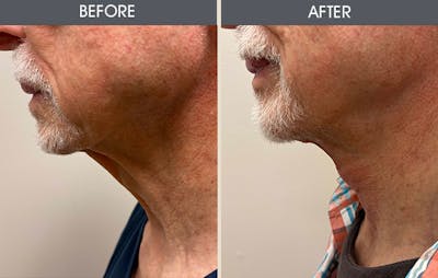 Neck Lift Gallery Before & After Gallery - Patient 163318 - Image 2
