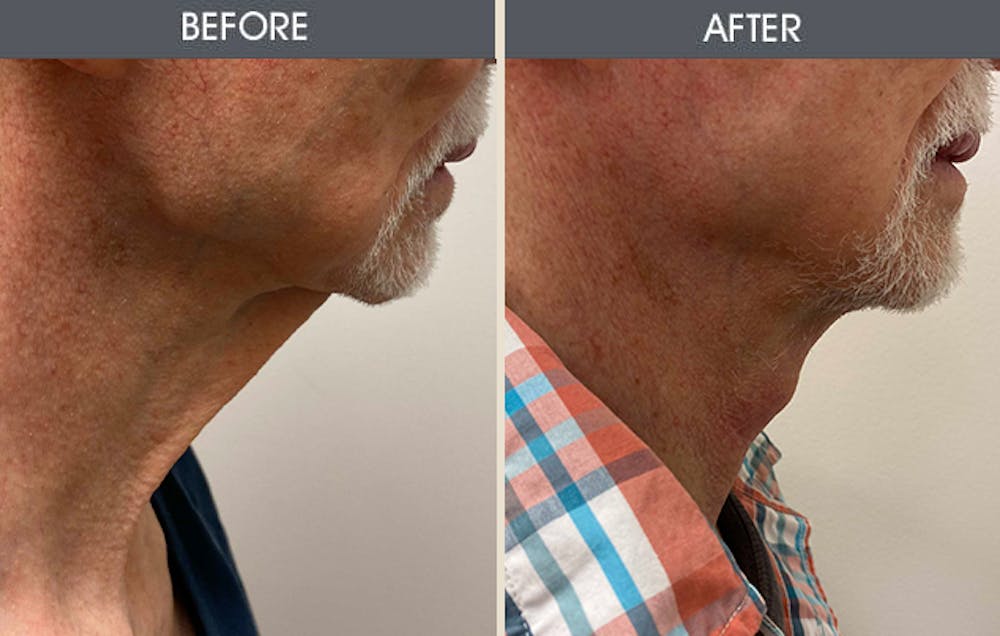 Neck Lift Gallery Before & After Gallery - Patient 163318 - Image 1