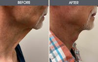 Neck Lift Gallery Before & After Gallery - Patient 163318 - Image 1