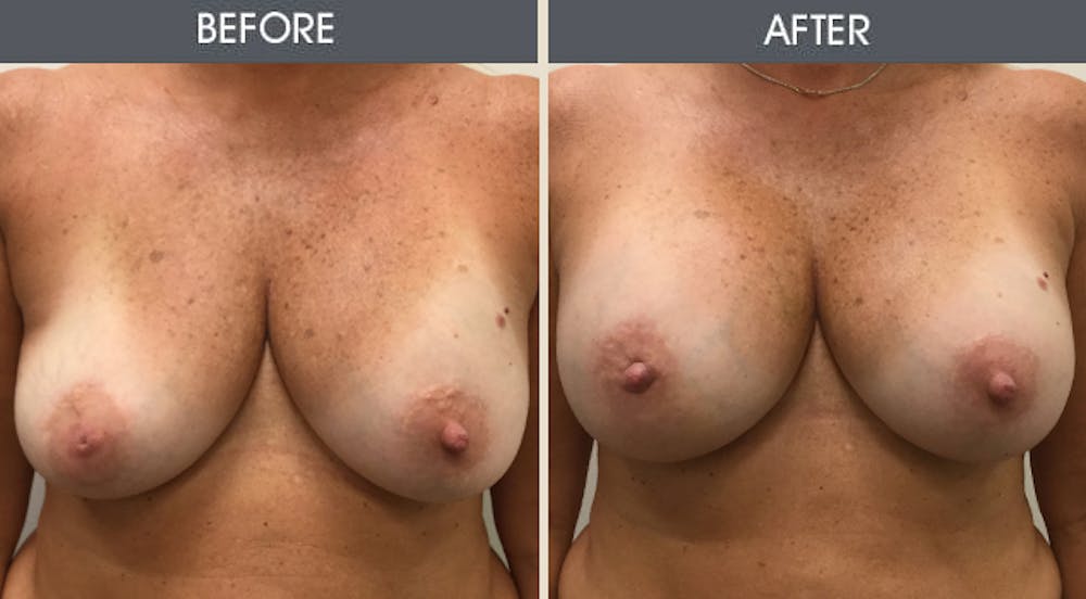 Breast Implant Revision Gallery Before & After Gallery - Patient 313459 - Image 1