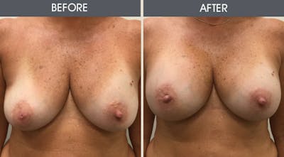 Breast Implant Revision Gallery Before & After Gallery - Patient 313459 - Image 1