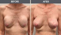 Breast Implant Revision Gallery Before & After Gallery - Patient 411801 - Image 1