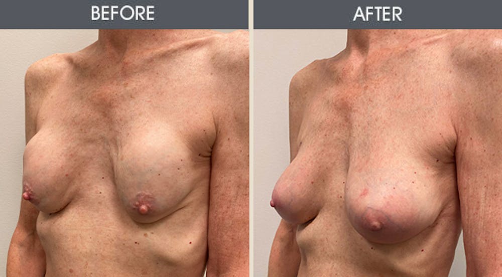 Breast Implant Revision Gallery Before & After Gallery - Patient 411801 - Image 2
