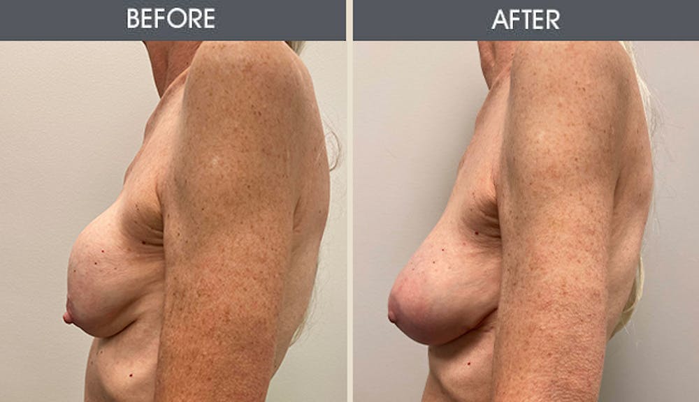 Breast Implant Revision Gallery Before & After Gallery - Patient 411801 - Image 3