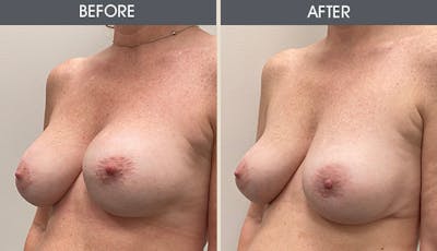 Breast Implant Revision Gallery Before & After Gallery - Patient 804100 - Image 2