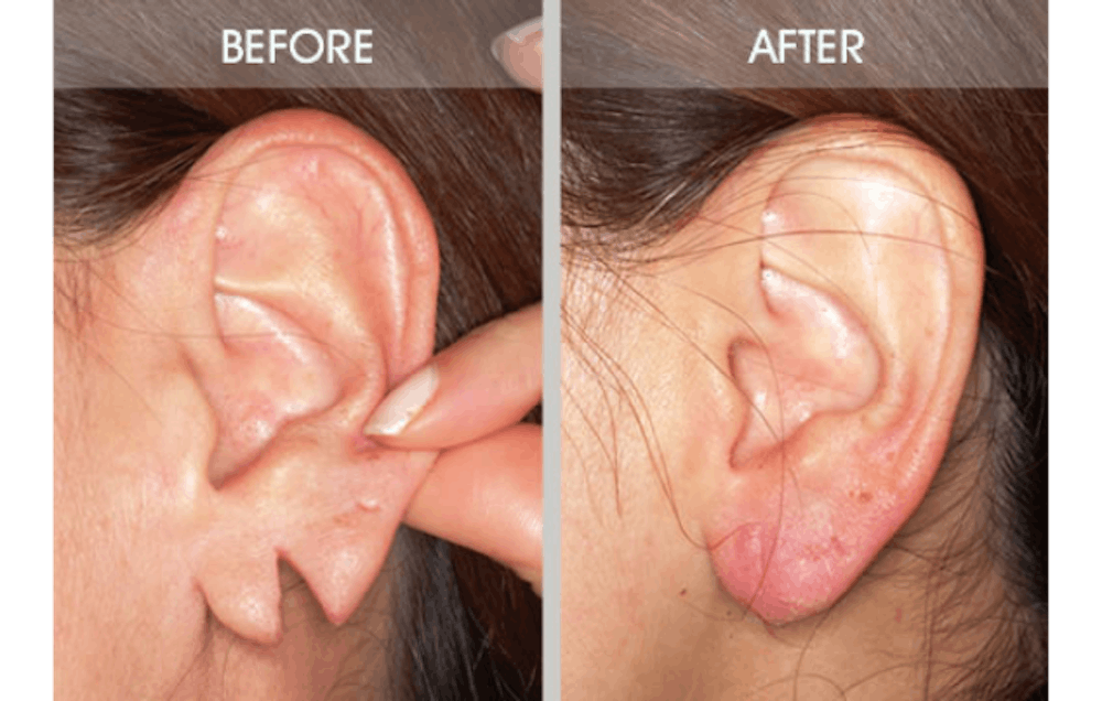 Earlobe Repair Gallery Before & After Gallery - Patient 2207110 - Image 1