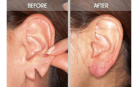 Earlobe Repair Gallery Before & After Gallery - Patient 2207110 - Image 1