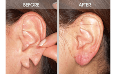 Earlobe Repair Gallery Before & After Gallery - Patient 2207110 - Image 1