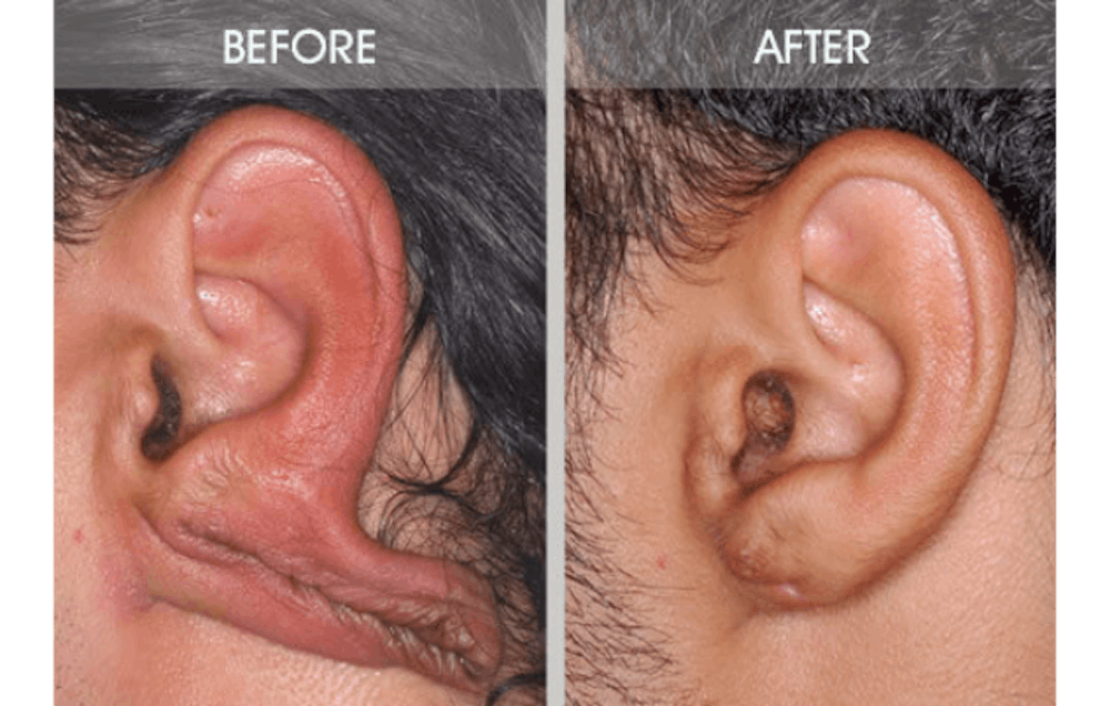Earlobe Repair Gallery Before & After Gallery - Patient 2207115 - Image 1