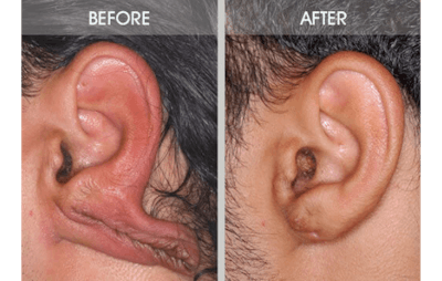 Earlobe Repair Gallery Before & After Gallery - Patient 2207115 - Image 1