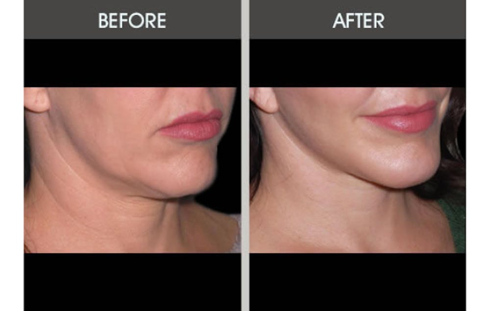 Facelift and Mini Facelift Gallery Before & After Gallery - Patient 2206186 - Image 1