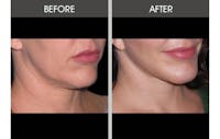 Facelift and Mini Facelift Gallery Before & After Gallery - Patient 2206186 - Image 1