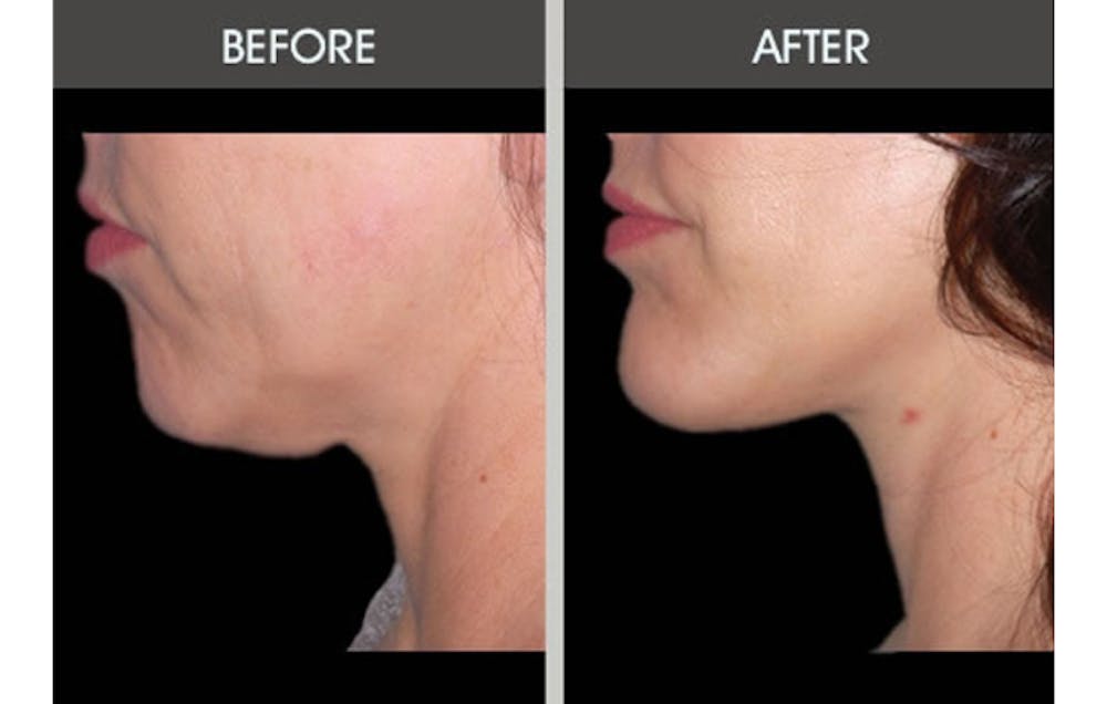 Facelift and Mini Facelift Gallery Before & After Gallery - Patient 2206186 - Image 2