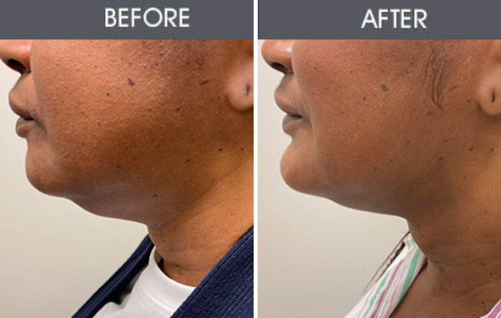 Submental Liposuction Gallery Before & After Gallery - Patient 192594 - Image 1