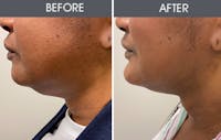 Submental Liposuction Gallery Before & After Gallery - Patient 192594 - Image 1
