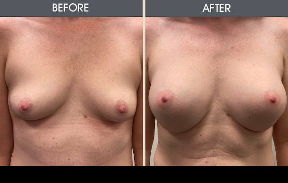 Breast Augmentation Gallery Before & After Gallery - Patient 607728 - Image 1