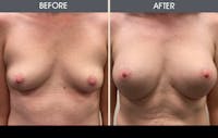 Breast Augmentation Gallery Before & After Gallery - Patient 607728 - Image 1