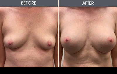 Breast Augmentation Gallery Before & After Gallery - Patient 607728 - Image 1