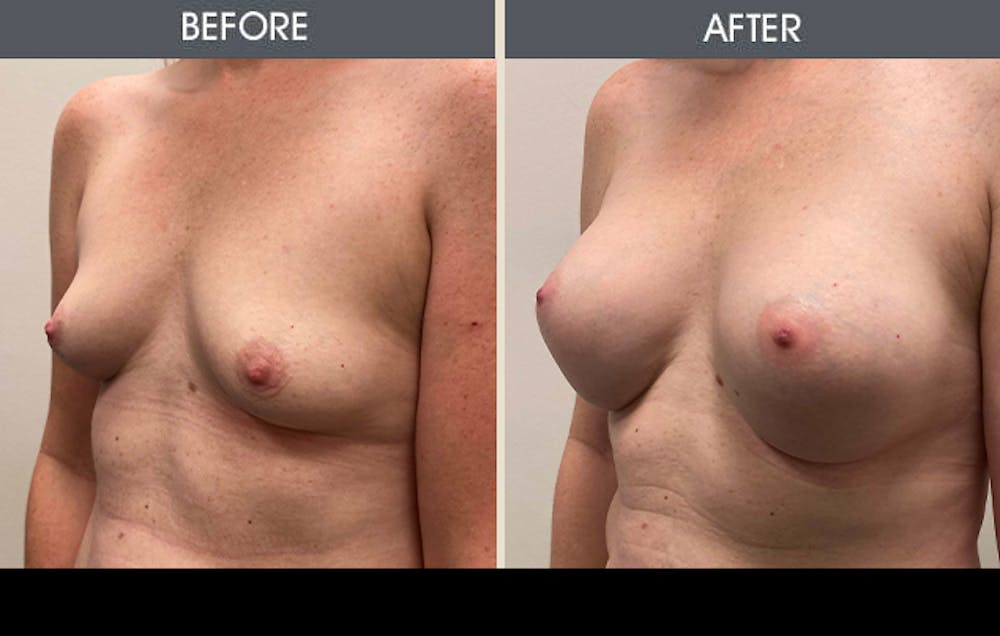 Breast Augmentation Gallery Before & After Gallery - Patient 607728 - Image 2