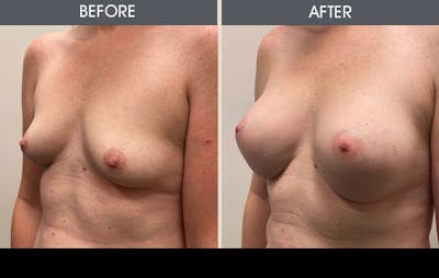 Breast Augmentation Gallery Before & After Gallery - Patient 607728 - Image 2