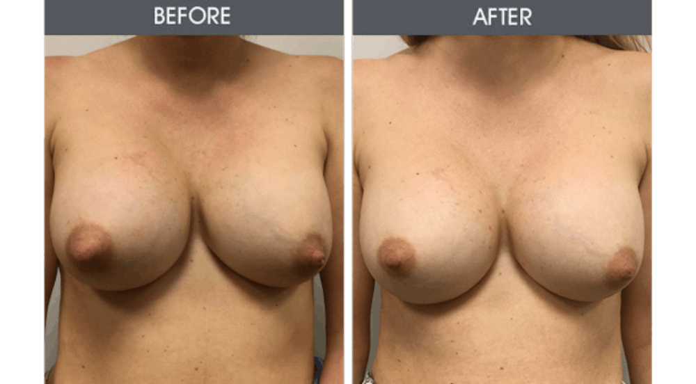 Breast Implant Revision Gallery Before & After Gallery - Patient 226771 - Image 1