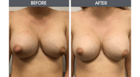 Breast Implant Revision Gallery Before & After Gallery - Patient 226771 - Image 1