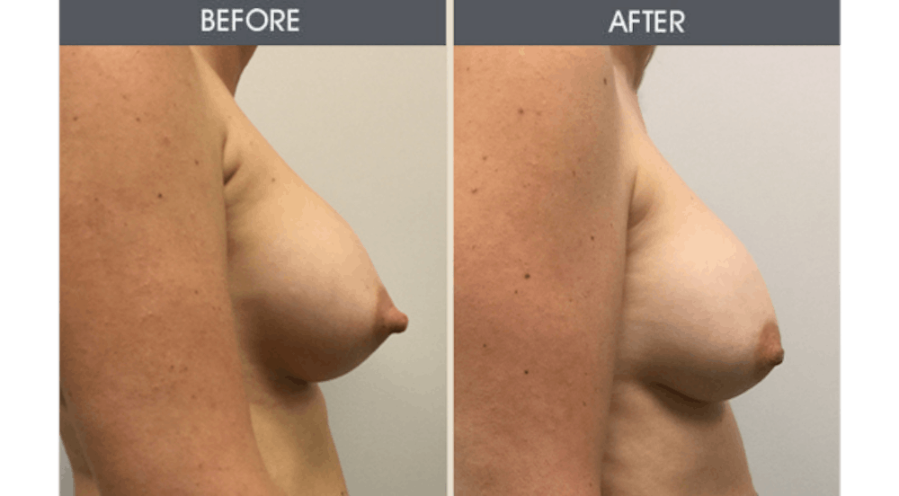 Breast Implant Revision Gallery Before & After Gallery - Patient 226771 - Image 2