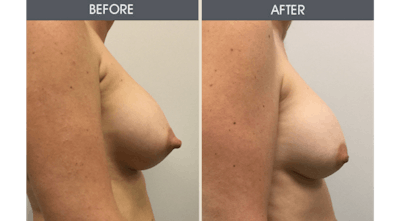 Breast Implant Revision Gallery Before & After Gallery - Patient 226771 - Image 2
