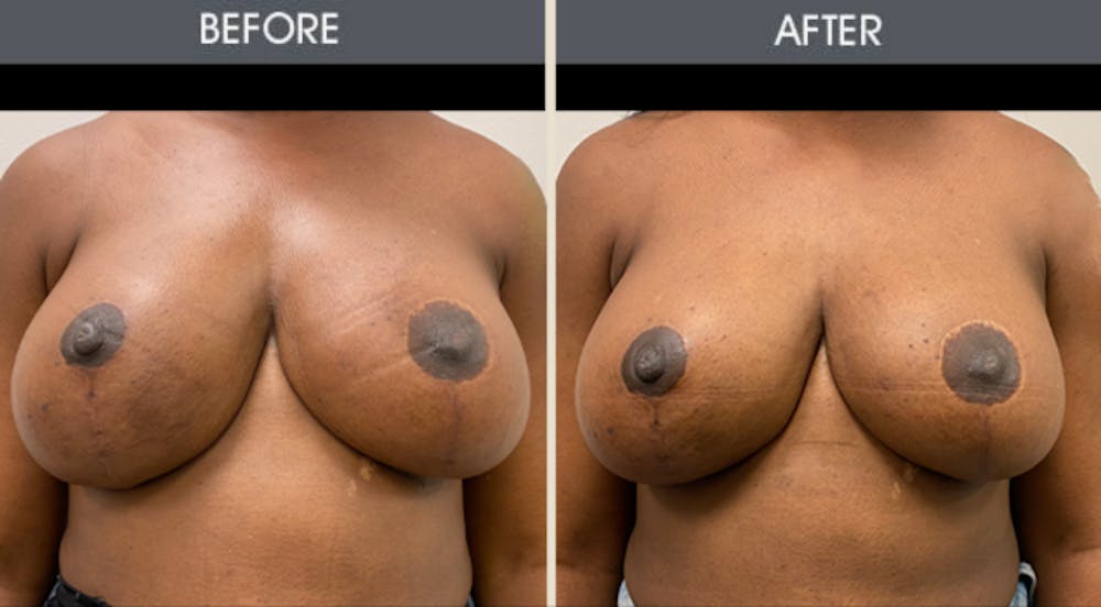 Breast Implant Revision Gallery Before & After Gallery - Patient 187354 - Image 1