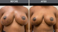 Breast Implant Revision Gallery Before & After Gallery - Patient 187354 - Image 1