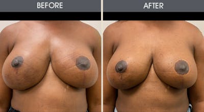 Breast Implant Revision Gallery Before & After Gallery - Patient 187354 - Image 1