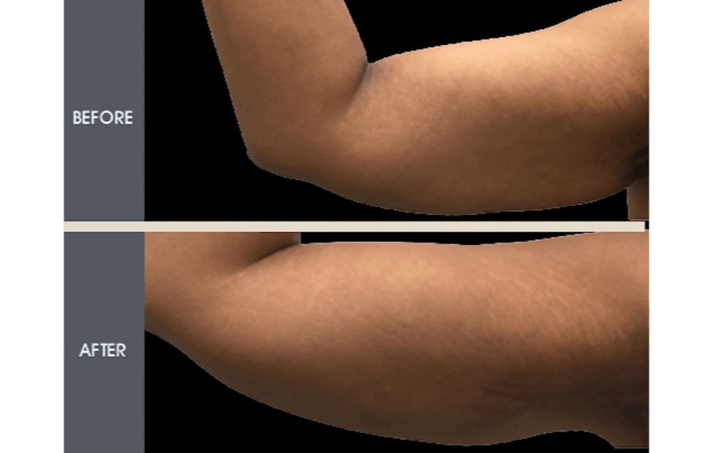 Arm Lift (Brachioplasty) Gallery Before & After Gallery - Patient 2207263 - Image 1
