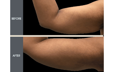 Arm Lift (Brachioplasty) Gallery Before & After Gallery - Patient 2207263 - Image 1
