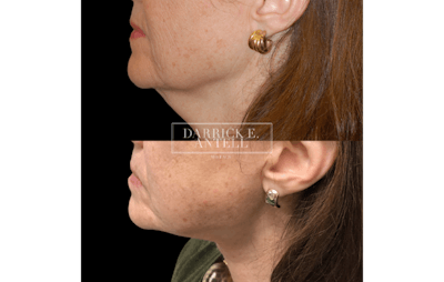 Lipoma Removal Gallery Before & After Gallery - Patient 148466863 - Image 1