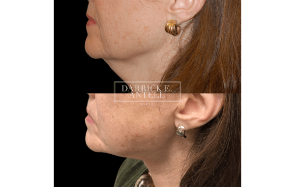 Lipoma Removal Gallery Before & After Gallery - Patient 148466863 - Image 1