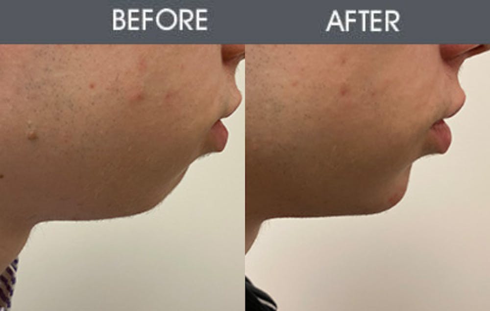 Dermal Fillers Gallery Before & After Gallery - Patient 187058637 - Image 1