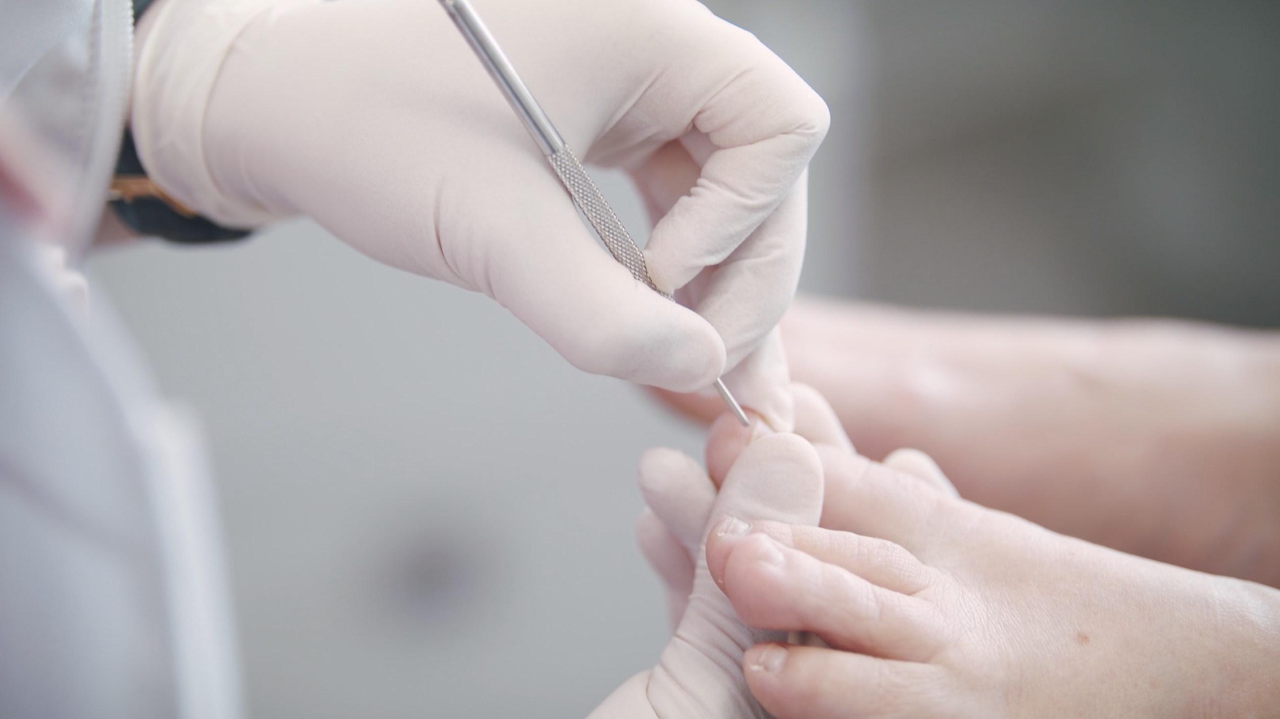 Les ongles incarnés Podiatre Justine Leduc