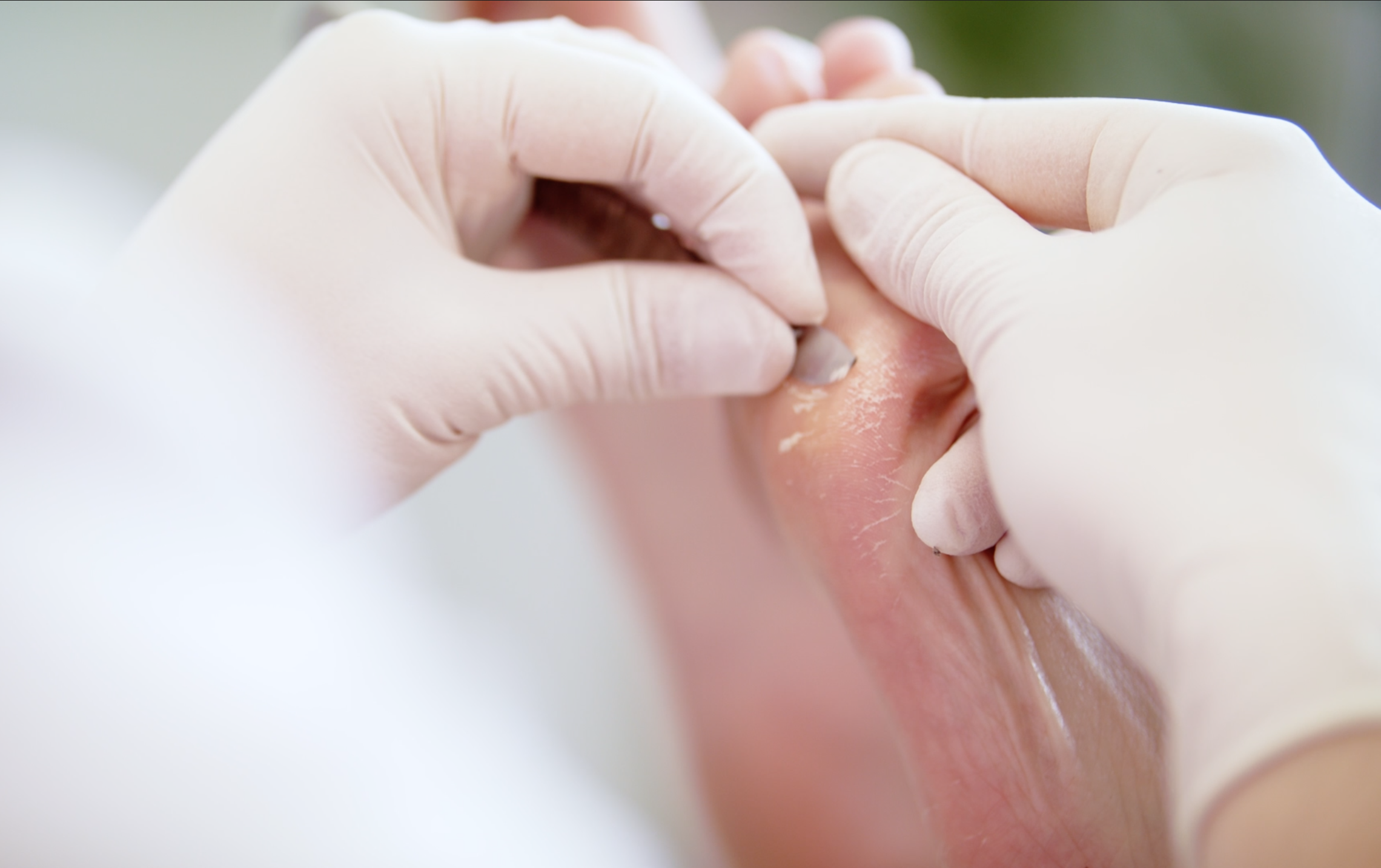 photo Pieds diabétiques et soins des plaies