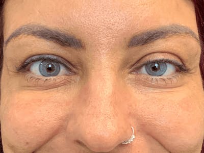 Blepharoplasty Before & After Gallery - Patient 275170 - Image 1