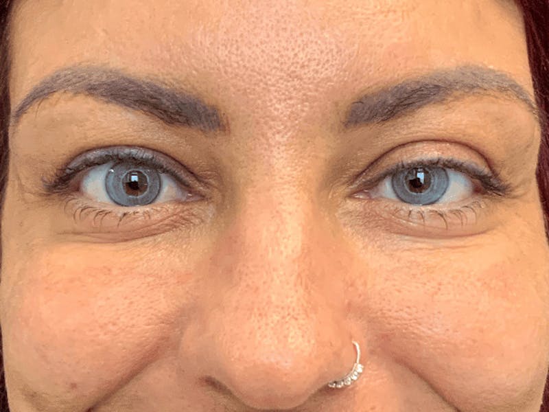 Blepharoplasty Before & After Gallery - Patient 275170 - Image 1