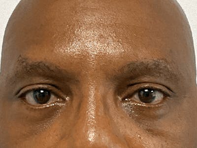 Blepharoplasty Before & After Gallery - Patient 326511 - Image 2