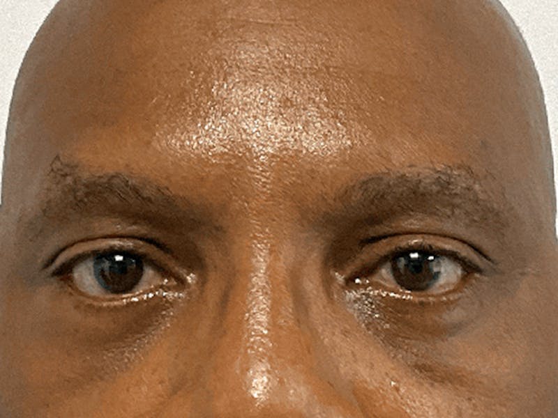 Blepharoplasty Before & After Gallery - Patient 326511 - Image 2