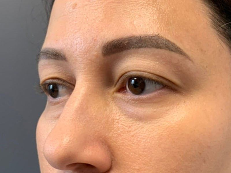 Blepharoplasty Before & After Gallery - Patient 410588 - Image 5