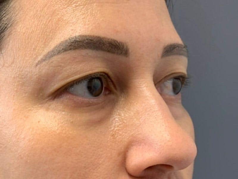 Blepharoplasty Before & After Gallery - Patient 410588 - Image 3