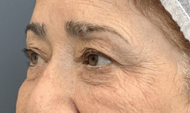 Blepharoplasty Before & After Gallery - Patient 867382 - Image 5