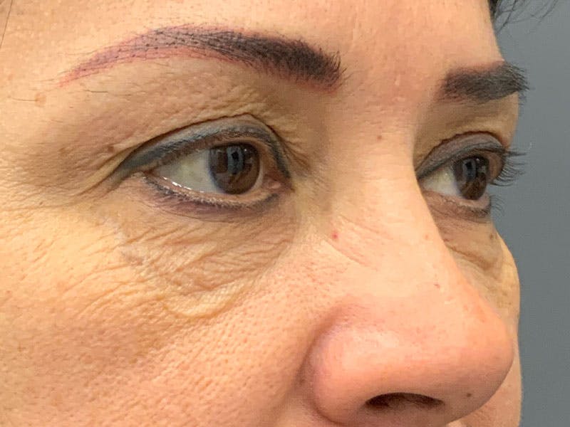 Blepharoplasty Before & After Gallery - Patient 341667 - Image 9