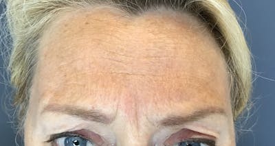 Botox Before & After Gallery - Patient 415012 - Image 1