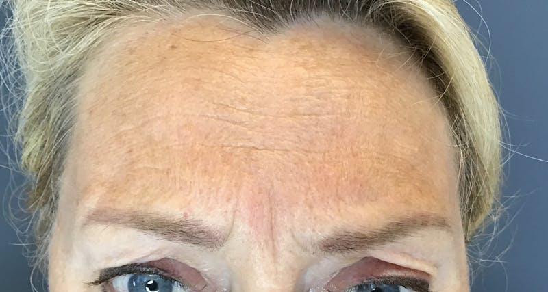 Botox Before & After Gallery - Patient 415012 - Image 1